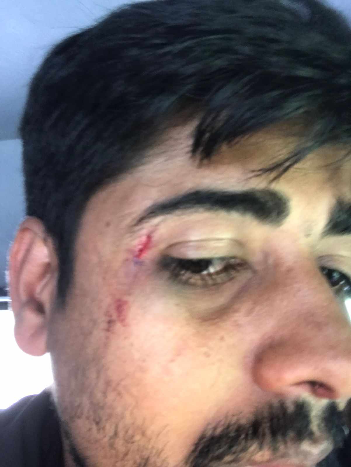 अधिकृतको कुटपिटबाट आँखामा चोट लागेका पीडित ।