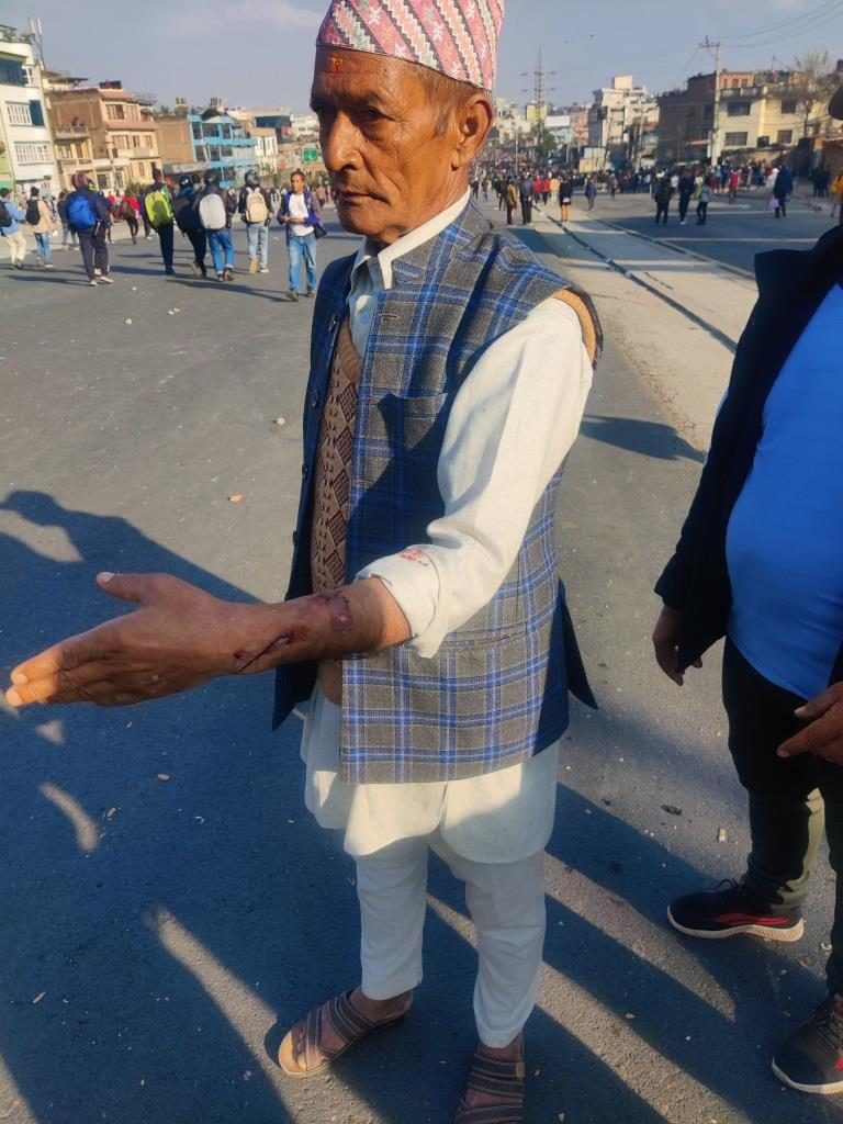 बल्खुमा प्रहरीको लाठीबाट घाइते हुनुभएका मिनकुमार तिमल्सिना